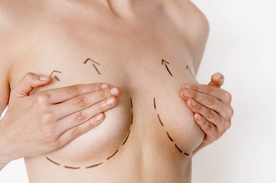 Breast Reduction Beverly Hills  Reduction Mammoplasty Los Angeles